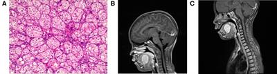 Alveolar soft part sarcoma in childhood and adolescence: Report of three cases and review of literature